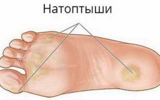 Виды натоптышей на пятках и как от них избавиться