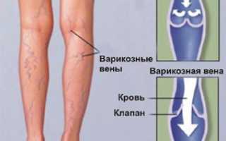 Ломота и боли в ногах ночью: причины и лечение
