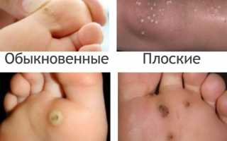 Виды бородавок на ногах и их лечение