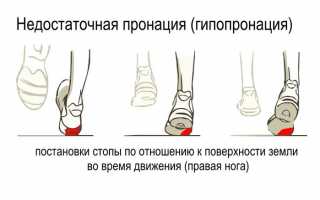 Что такое пронация стопы и ее типы